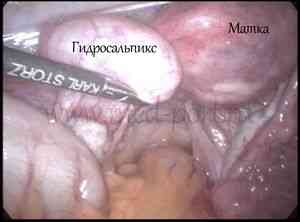 Непроходимость маточных труб лечение - лапароскопия маточных труб ...
