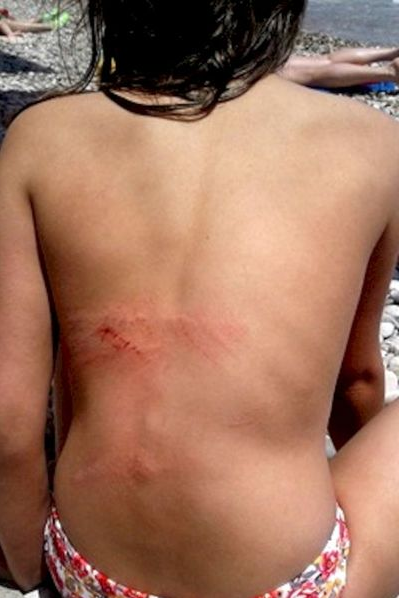 На пляже крымского курорта получила травму восьмилетняя девочка [фото]